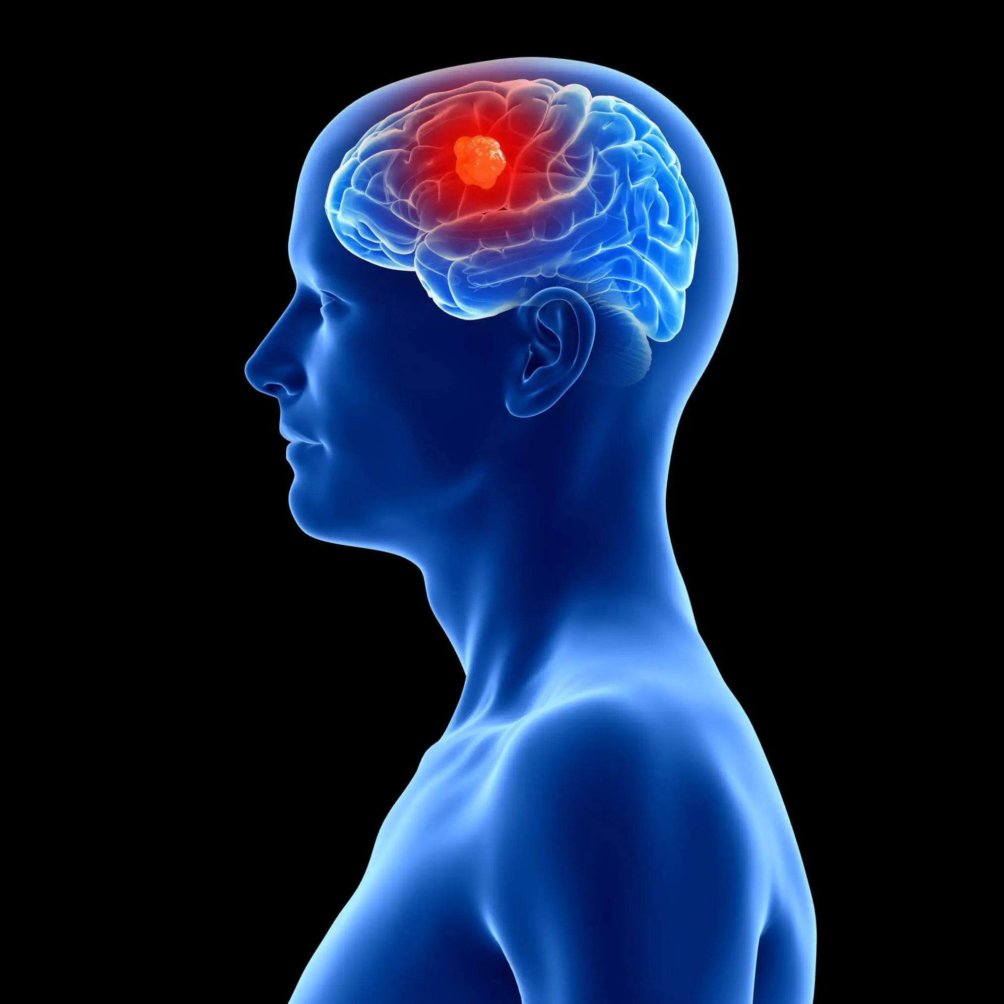 Novo implante cerebral quer detetar sinais de cancro mais cedo